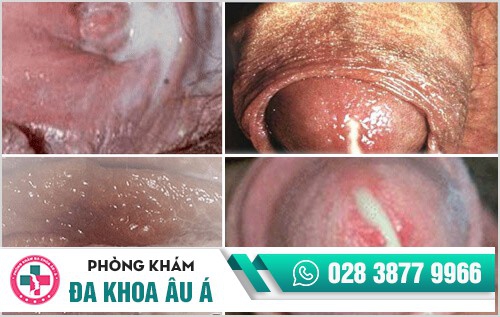 Cận cảnh hình ảnh bệnh lậu ở các vị trí trên cơ thể