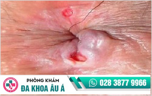 Hình ảnh bệnh lậu mãn tính