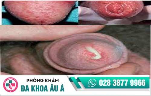 hình ảnh bệnh lậu ở nam giới