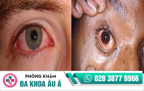 hình ảnh bệnh lậu ở nam giới