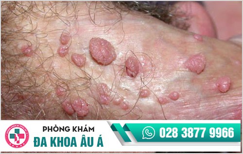 hình ảnh sùi mào gà