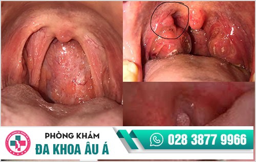 hình ảnh sùi mào gà