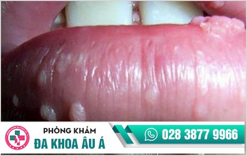 hình ảnh sùi mào gà