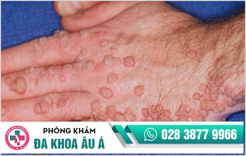 hình ảnh sùi mào gà