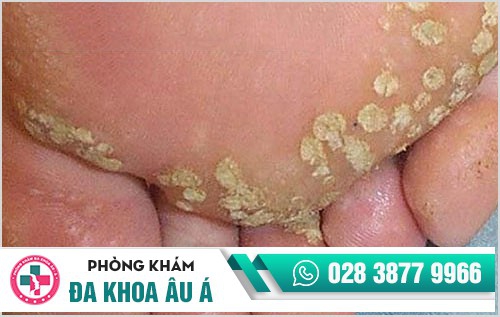 hình ảnh sùi mào gà