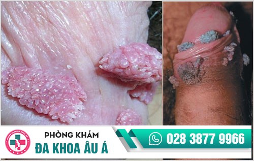 hình ảnh sùi mào gà