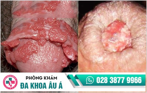 hình ảnh sùi mào gà