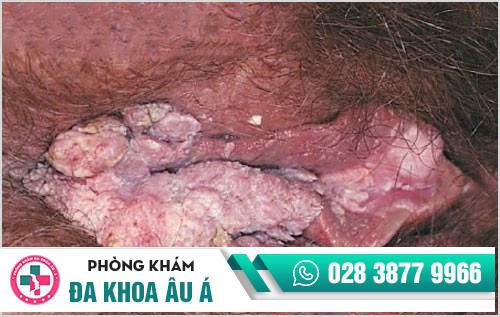 hình ảnh sùi mào gà