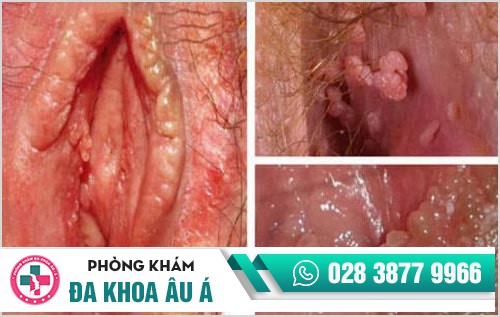 hình ảnh sùi mào gà