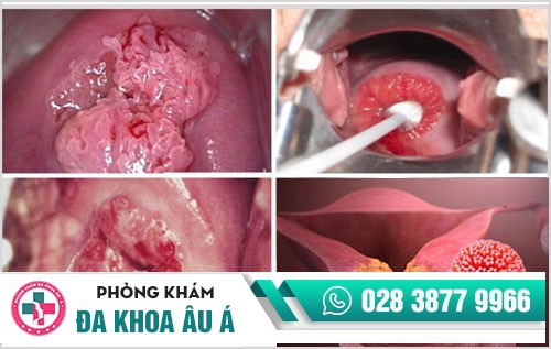 hình ảnh sùi mào gà