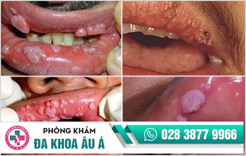 hình ảnh sùi mào gà