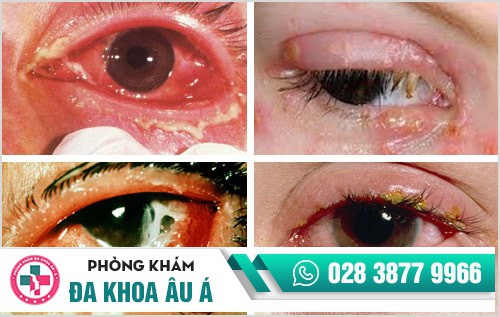 hình ảnh sùi mào gà