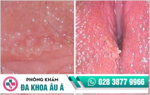 Gai âm đạo là gì? Phân biệt gai âm đạo và sùi mào gà