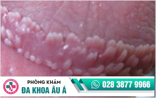 Hình ảnh hạt ngọc dương vật