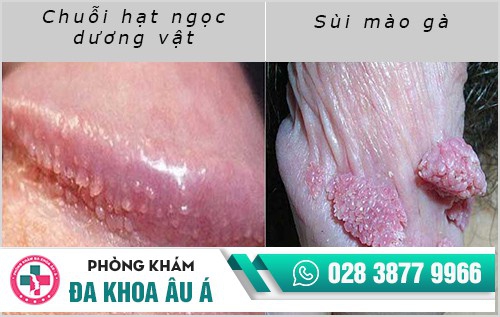 Hình ảnh hạt ngọc dương vật