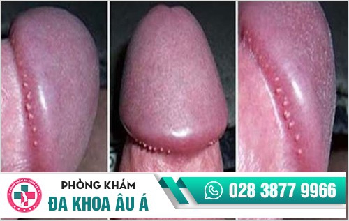 Hình ảnh hạt ngọc dương vật
