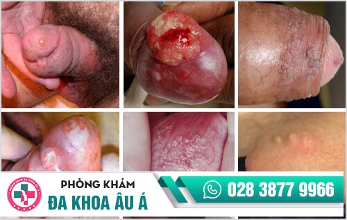 Nổi mụn bao quy đầu