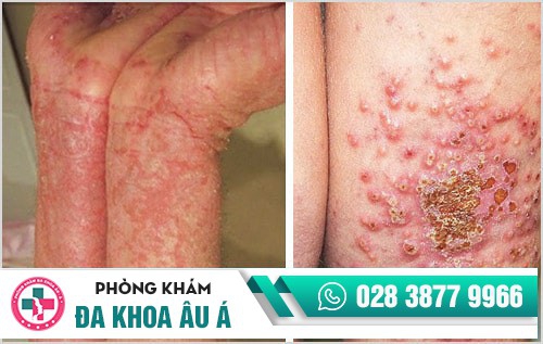 Viêm da dị ứng là gì? Cách điều trị bệnh hiệu quả