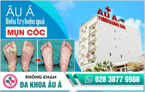mụn cóc