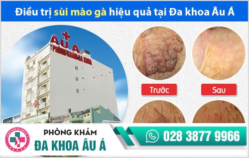 địa chỉ chữa sùi mào gà