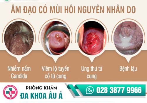 ÂM ĐẠO BỊ HÔI