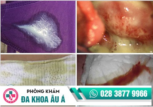 Bắt bệnh phụ khoa qua màu sắc bất thường của khí hư
