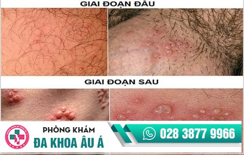 vùng kín mọc mụn