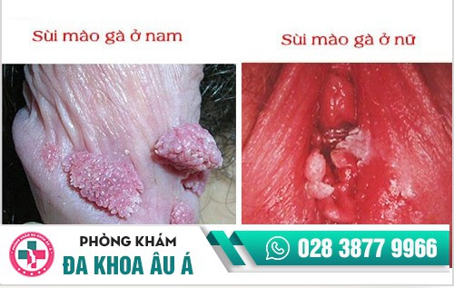 vùng kín mọc mụn