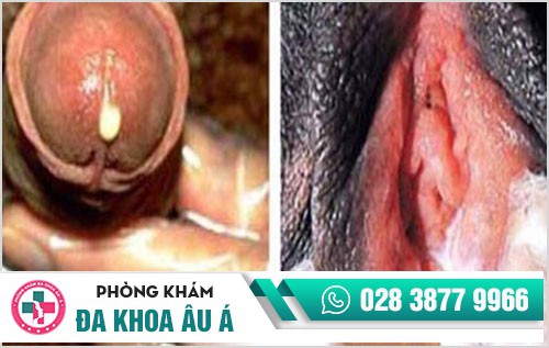 Nguy cơ tử vong cao khi mắc bệnh lậu mãn tính