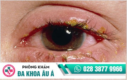 Biểu hiện bệnh lậu - đa số đều không biết đến thông tin này