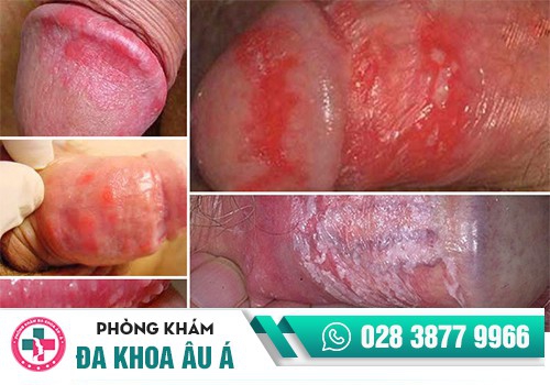 Bệnh lậu dẫn đến hình thành bợn trắng bao quy đầu