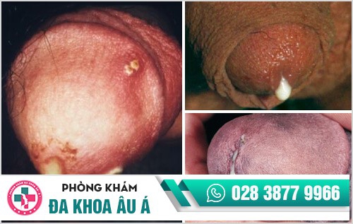 Lỗ sáo chảy mủ là bị bệnh gì