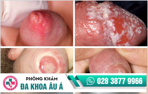 Lỗ sáo chảy mủ là bị bệnh gì