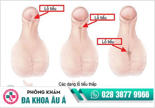 Hẹp lỗ tiểu do bẩm sinh