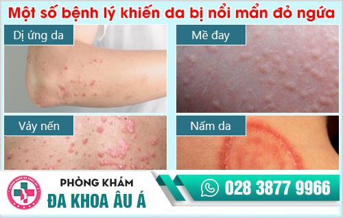 mẩn đỏ ngứa