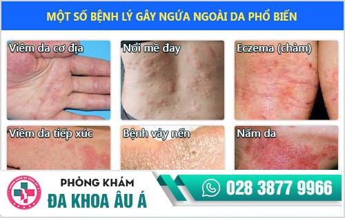 bệnh bạch biến