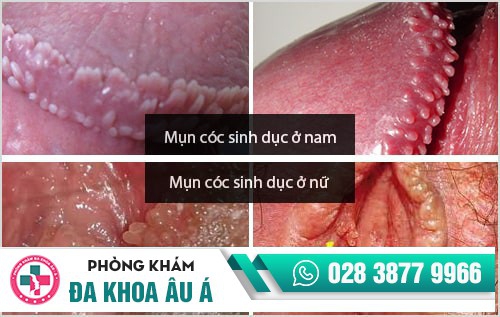 mụn cóc