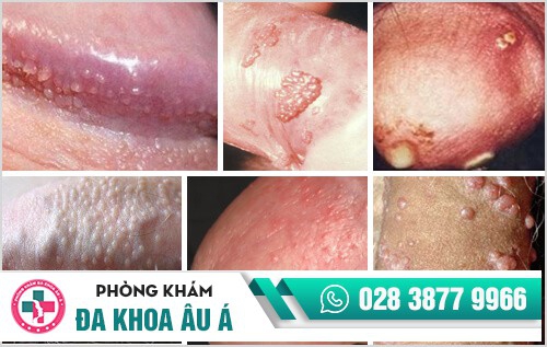 thuốc chữa trị mụn dương vật 