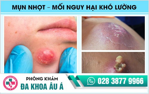 Mụn nhọt – Mối nguy hại khó lường