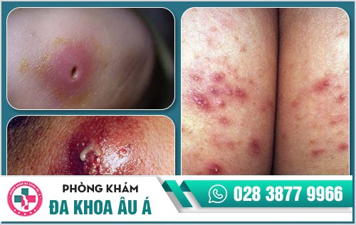 mụn nhọt ở mông