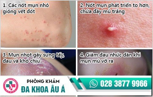 Dấu hiệu bị mụn nhọt tay, chân