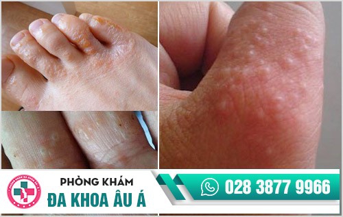 Hình ảnh bệnh ghẻ ngứa