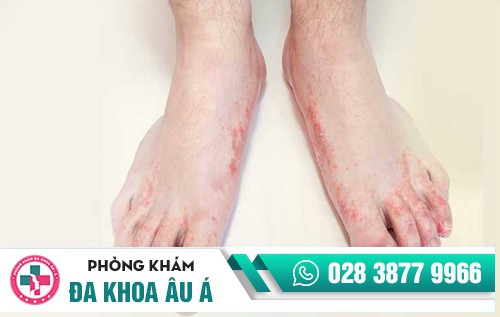 nổi mụn nước ở chân