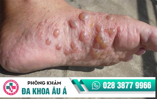 mụn nước ở chân