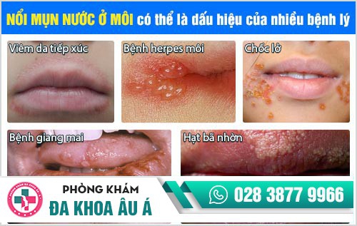 mụn nước ở môi