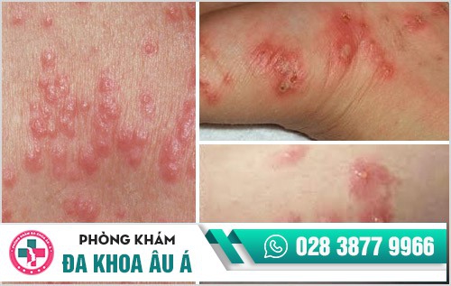 Hình ảnh bệnh ghẻ ngứa