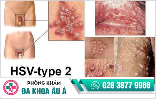 Tổng quan về mụn rộp sinh dục