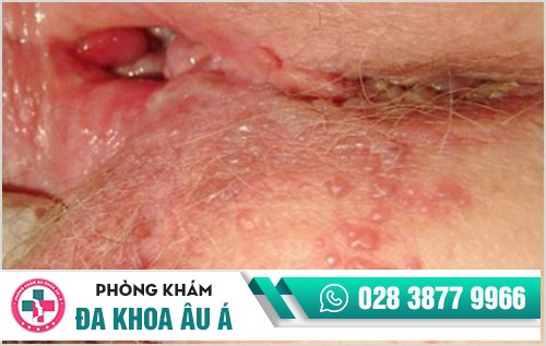 Mụn rộp sinh dục