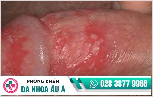 Mụn rộp sinh dục