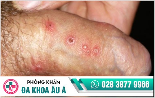 Tổng quan về mụn rộp sinh dục